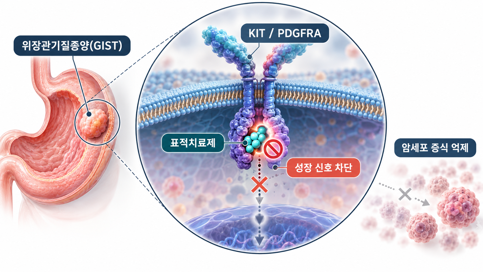 위장관기질종양 GIST 표적치료 원리를 보여주는 일러스트